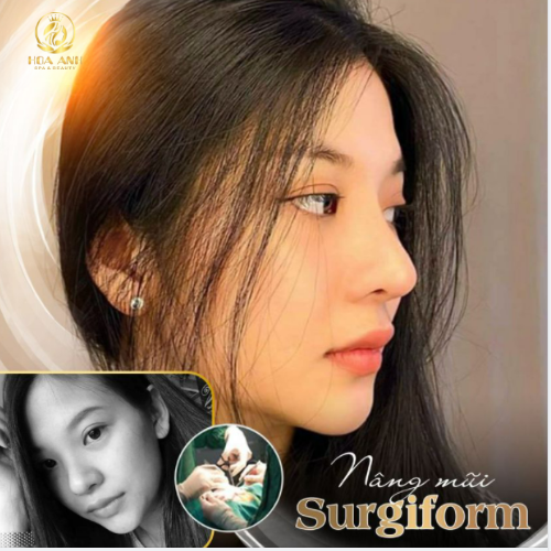 Nâng mũi Surgiform là gì? Giá bao nhiêu?